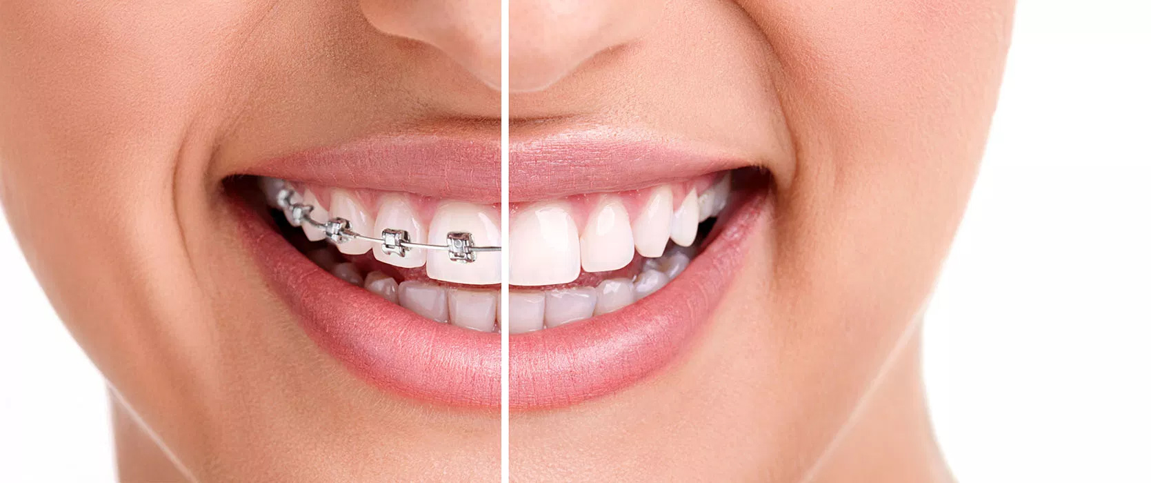 Magic Touch Orthodontist | Crowding, Facial Imbalance and Damon Braces